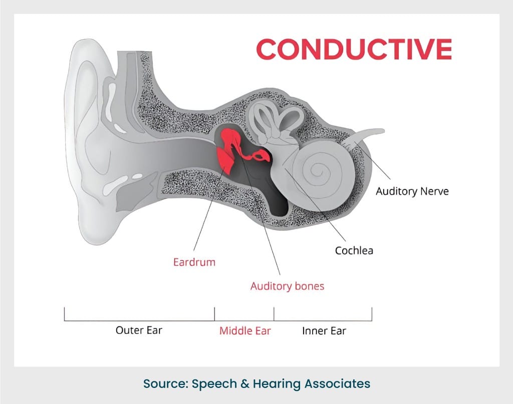 Conductive Hearing Loss