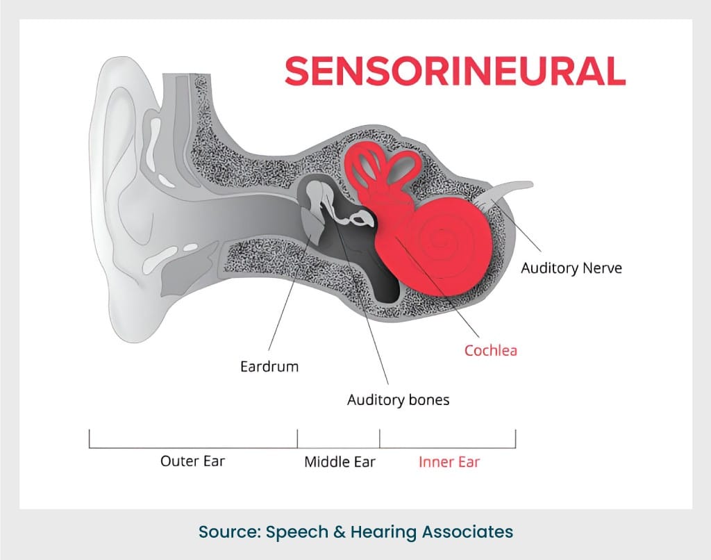 Sensorineural hearing loss affects the inner ear